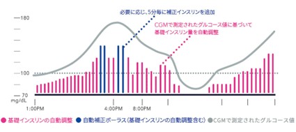 SAP（リアルタイムCGM搭載インスリンポンプ）のメリット・デメリット イメージ