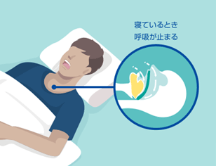 睡眠時無呼吸症候群（SAS）