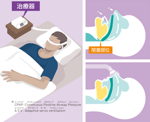 睡眠時無呼吸症候群(SAS)